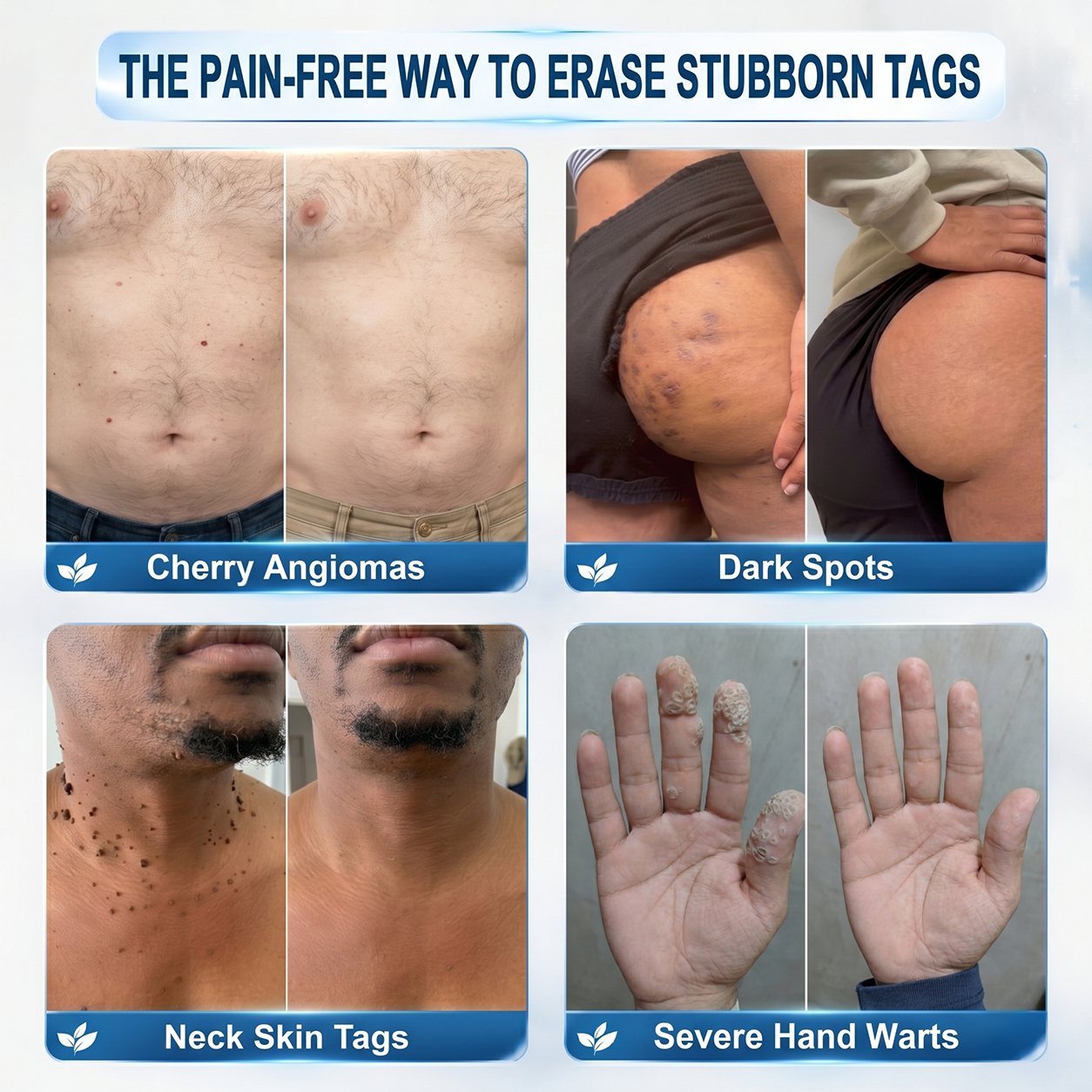 𝐉𝐎𝑼𝐒®🔥 Official Store7-𝐷𝑎𝑦 𝗧𝐚𝐠 & 𝗦𝗽𝐨𝐭 𝐄𝐫𝒂𝒔𝒆𝒓(Zero Pain, Zero 𝐒𝐜𝐚𝒓𝒔 Rollerball)
